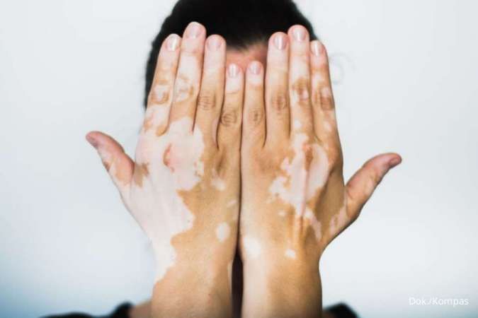 4 Fakta Tentang Vitiligo yang Harus Anda Tahu, Apakah Vitiligo Menular?