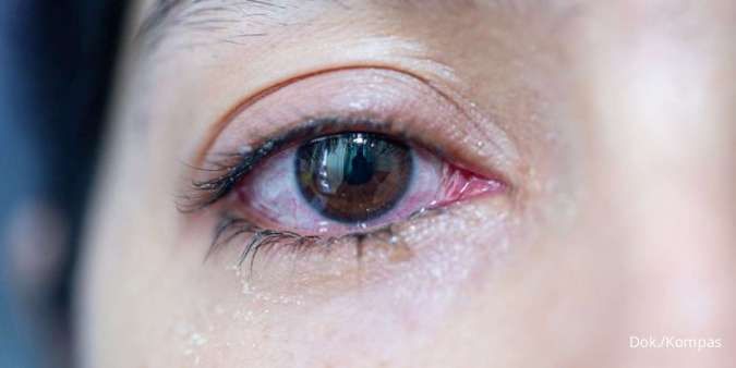 Tanda-Tanda Awal Kolesterol Tinggi di Mata, Jangan Abaikan