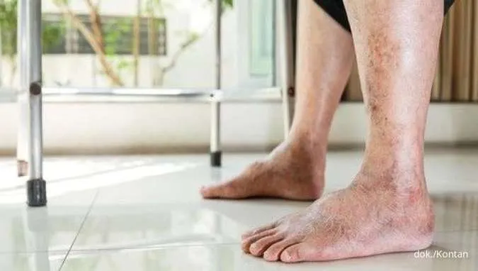 11 Tanda Diabetes pada Kulit yang Tidak Banyak Diketahui, Apa Saja?