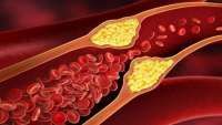 Alternatif Obat Kolesterol Selain Statin yang Aman: Penurunan hingga 50%