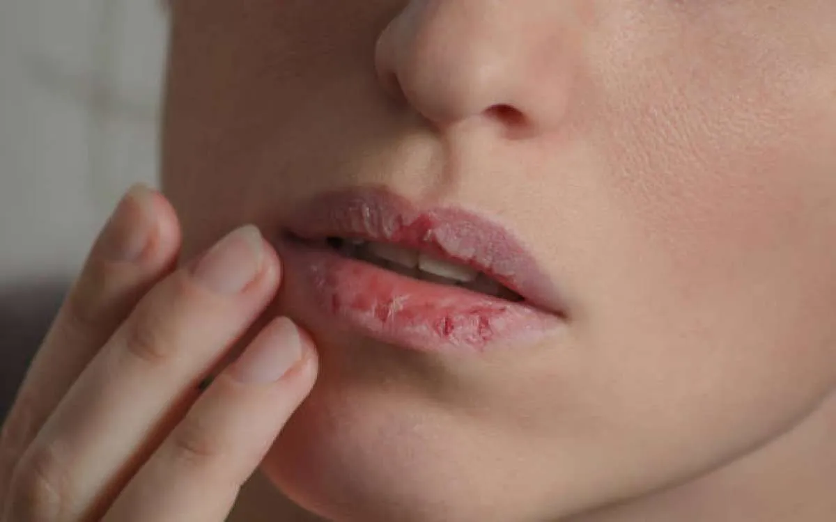 Melembabkan, 6 Cara Mengatasi Bibir Kering Ini Patut Anda Coba