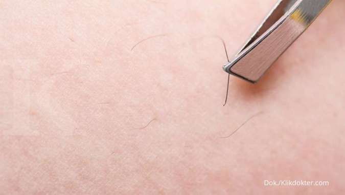 Kenali Ingrown Hair, Salah Satu Penyebab Munculnya Chicken Skin pada Kulit!