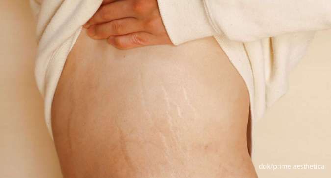 Minder Karena Guratan? Ini 8 Tips Hilangkan Stretch Mark di Beberapa Bagian Tubuh