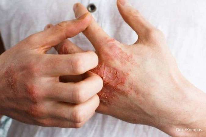 Bukan Sekadar Penyakit Kulit, Kenali Gejala dan Penanganan Psoriasis