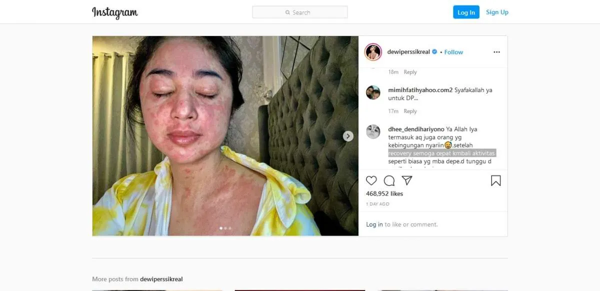 Pahami ciri-ciri ruam kulit yang menjadi gejala Covid-19 seperti dialami Dewi Perssik